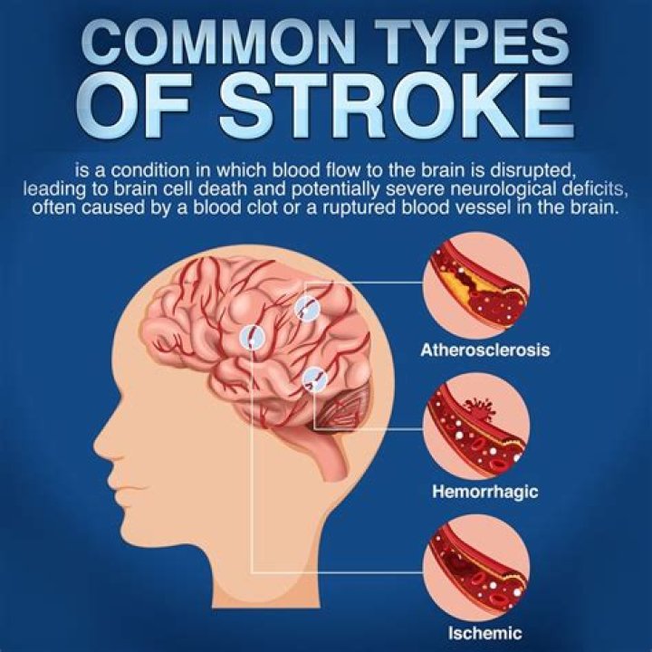 When Did Harry Connick Jr. Have A Stroke? A Comprehensive Overview